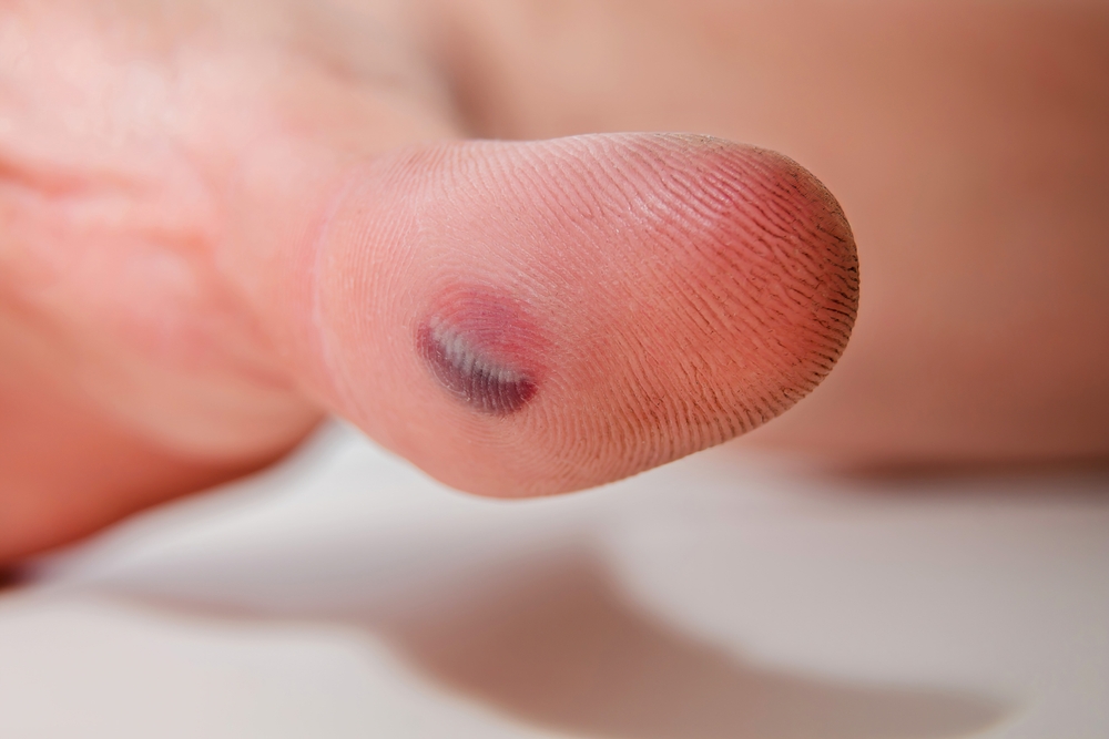 blutblase am finger