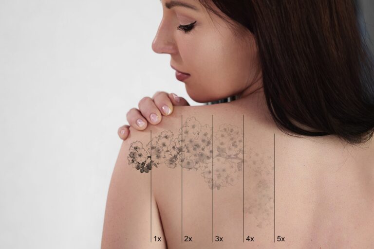Tattoos entfernen: Das sollte man wissen